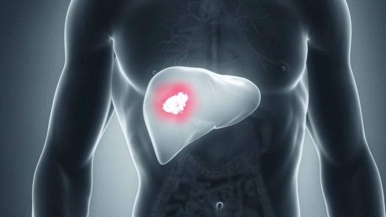 Cancerul hepatic (carcinom hepatocelular)