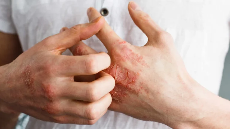 Dermatita atopică: controlul pielii sensibile și iritate Dermatita atopică