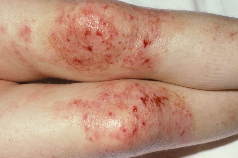Dermatite și eczeme – cauze, tipuri, simptome și tratamente Dermatitele și eczemele