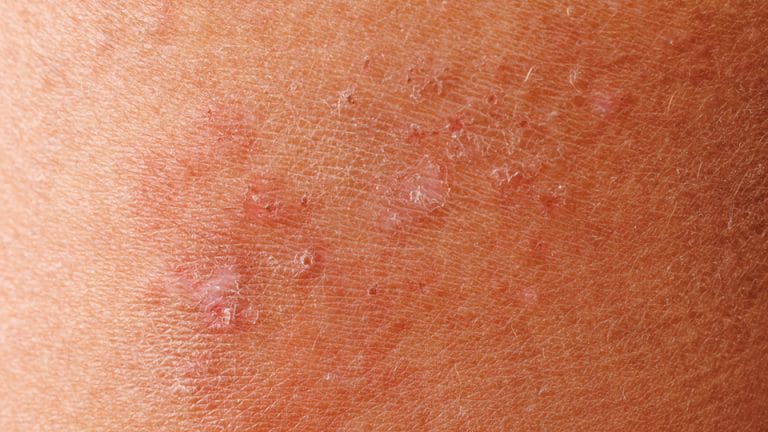 Eczema vs Dermatită: Diferențe, Tratamente și Sfaturi Complete Eczema