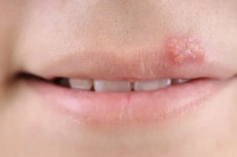 Herpes simplex: simptome, cauze, tratament și prevenție Herpes simplex