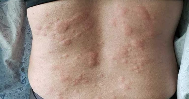 Urticaria: Cauze, Simptome, Tratament și Prevenție Urticaria
